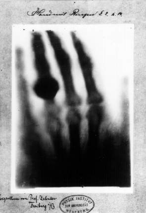 Первый рентгеновский снимок — кисть руки жены Рентгена, 22 декабря 1895 года
