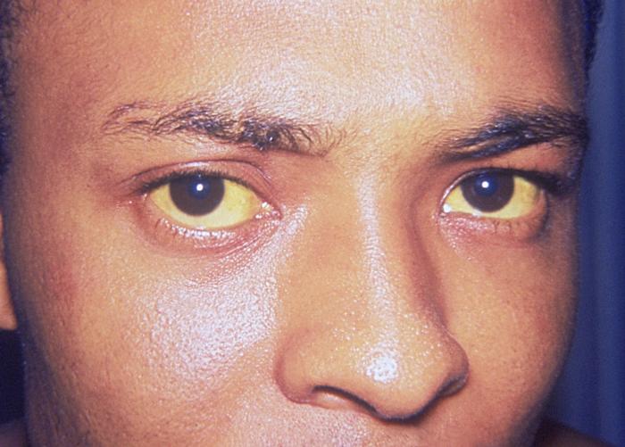Желтизна глаз и кожи при гепатите А