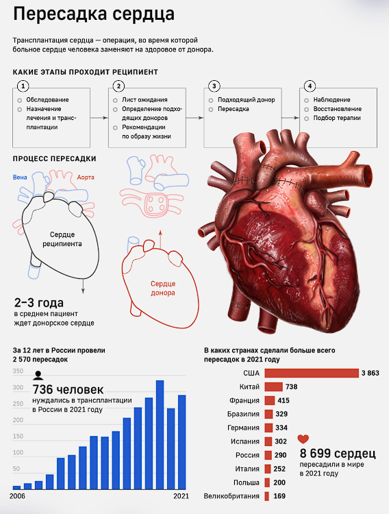 Интересные факты о пересадке сердца