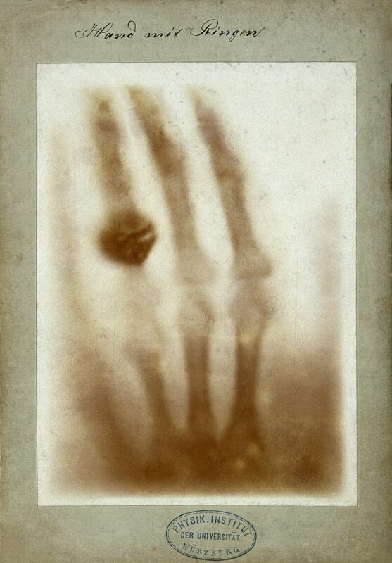 "Рука с кольцами" — первый рентгеновский снимок человеческого организма